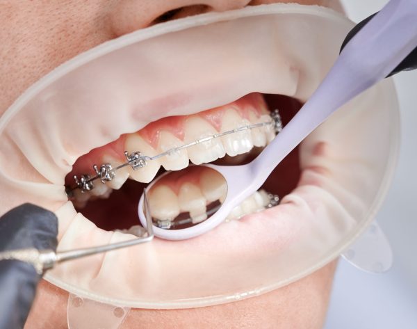 Close up of orthodontist placing orthodontic brackets on patient teeth. Person with cheek retractor and metal braces on teeth having dental procedure in clinic. Concept of orthodontic treatment.